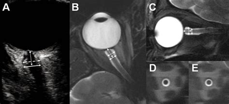 optic nerve thickness measurement radiology|normal optic nerve thickness.